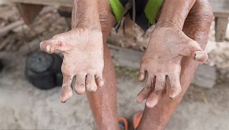 Cases of leprosy rising in Florida, new report shows